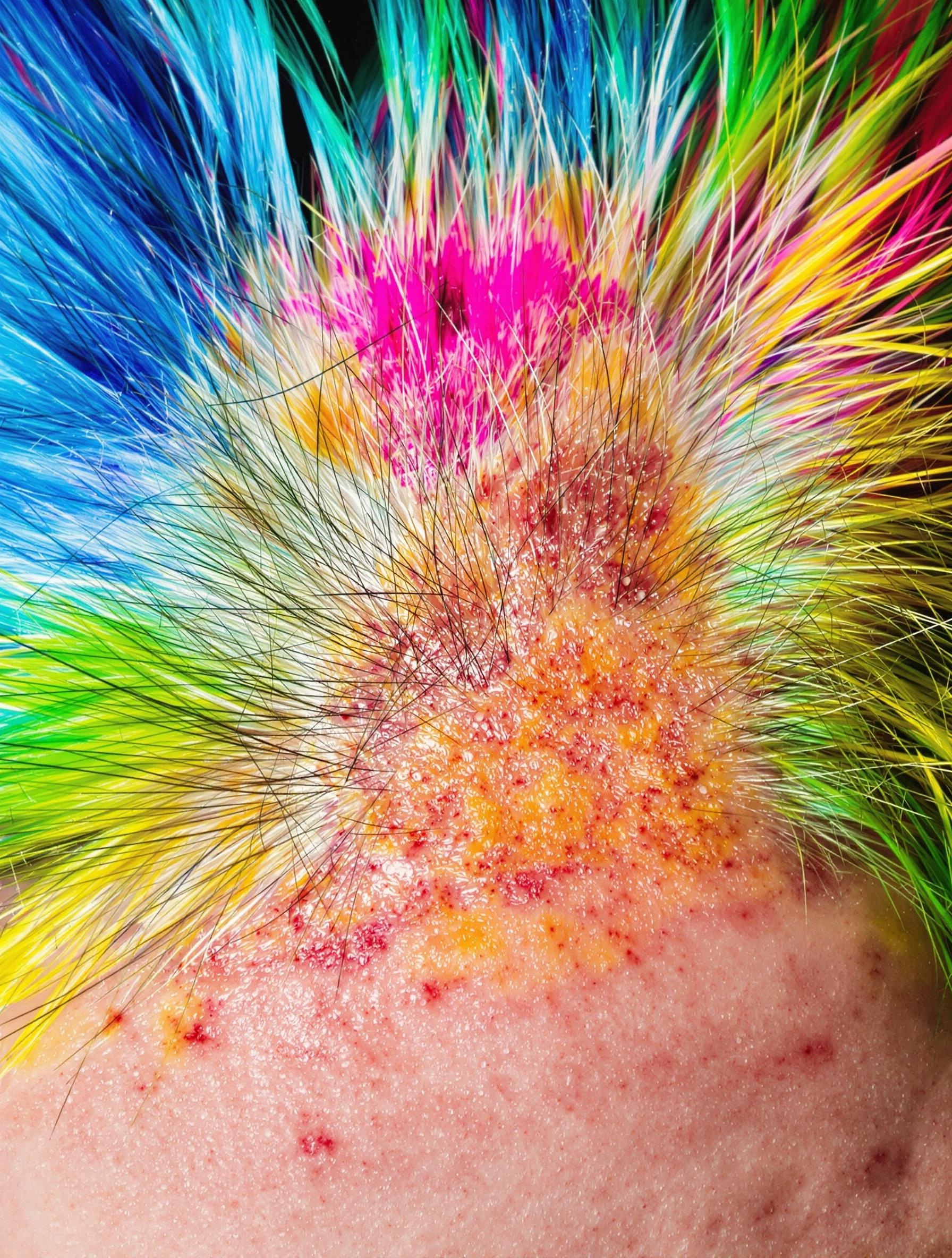 Cheveux colorés avec des taches irrégulières et irritation du cuir chevelu